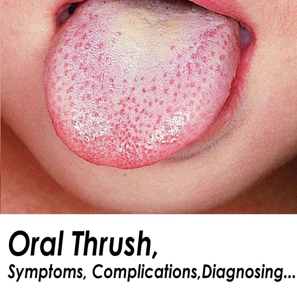Symtoms Of Oral Thrush 55