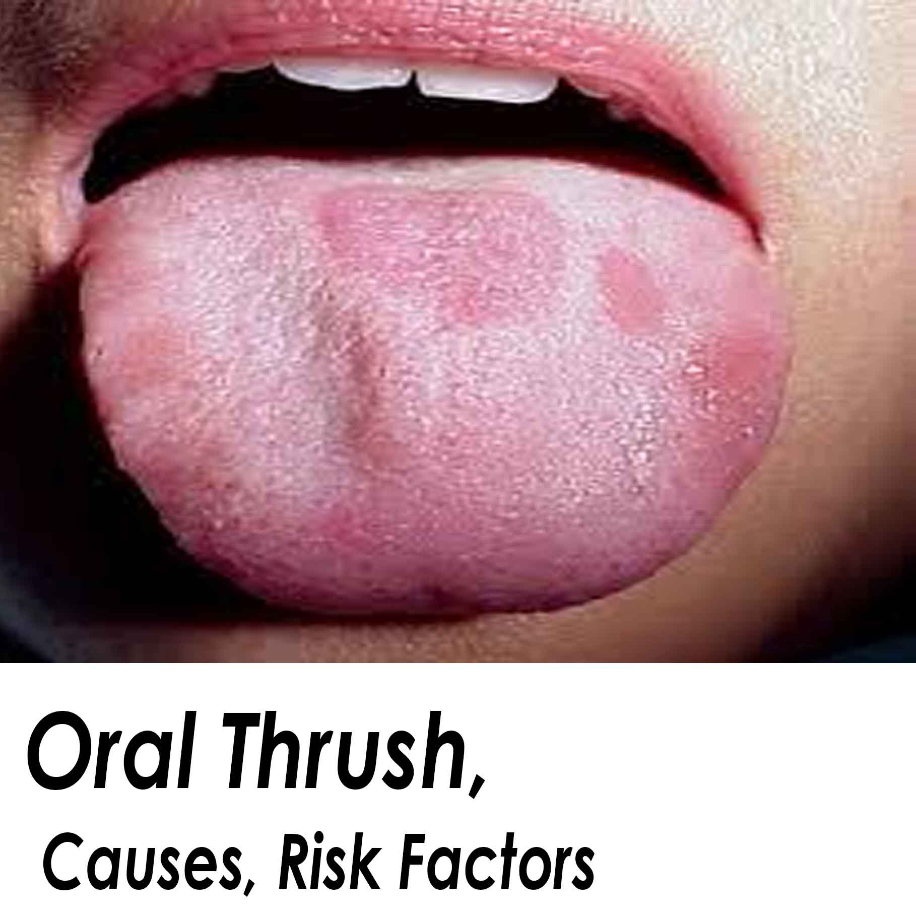 Symptoms, Treatment And Prevention Of Oral Candidiasisoral Thrush