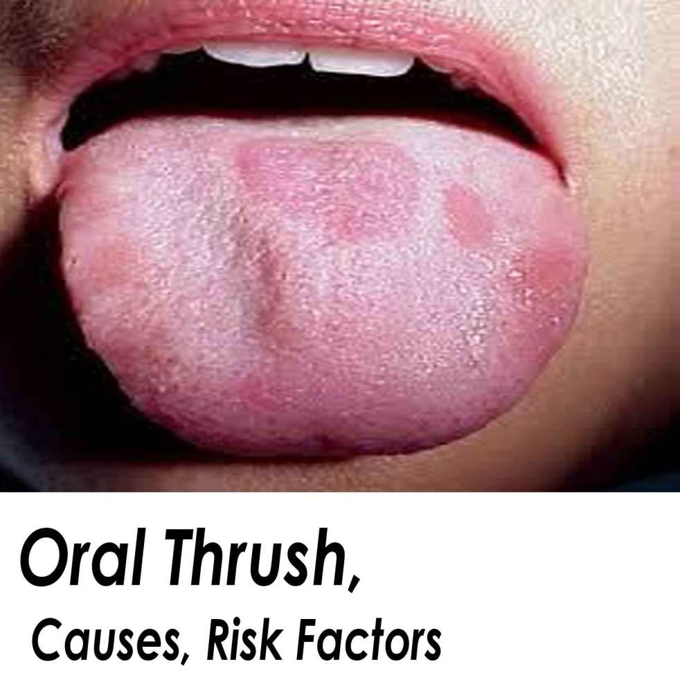 Cause Of Oral Thrush 71